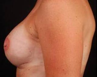 Immediate Breast Reconstruction – Flaps Before & After Gallery - Patient 352908 - Image 4