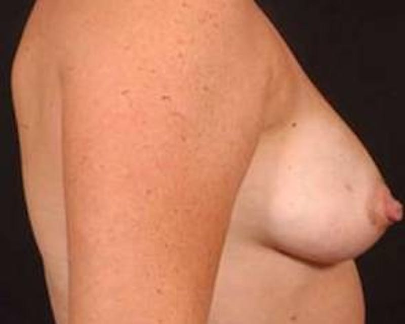 Immediate Breast Reconstruction – Flaps Before & After Gallery - Patient 352908 - Image 5