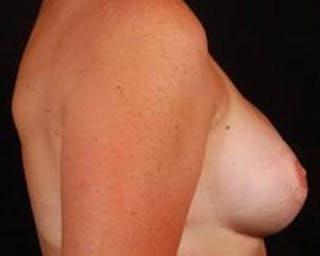 Immediate Breast Reconstruction – Flaps Before & After Gallery - Patient 352908 - Image 6