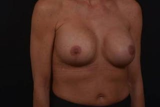 Breast Augmentation Mastopexy Before & After Gallery - Patient 168662 - Image 4