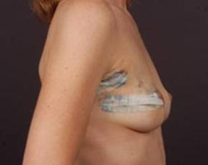 Immediate Breast Reconstruction – Flaps Before & After Gallery - Patient 139475 - Image 3