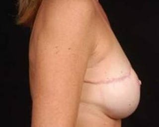 Immediate Breast Reconstruction – Flaps Before & After Gallery - Patient 139475 - Image 4