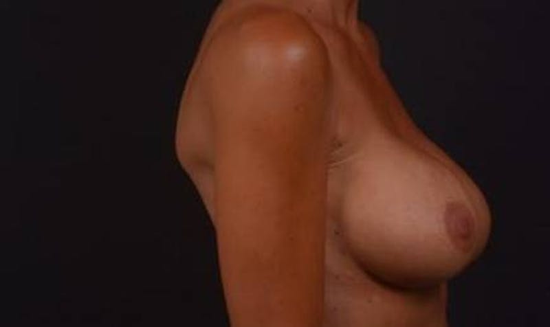 Breast Augmentation Mastopexy Before & After Gallery - Patient 168662 - Image 7