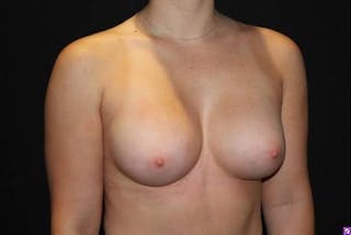 Breast Augmentation Silicone Gel Before & After Gallery - Patient 387690 - Image 8