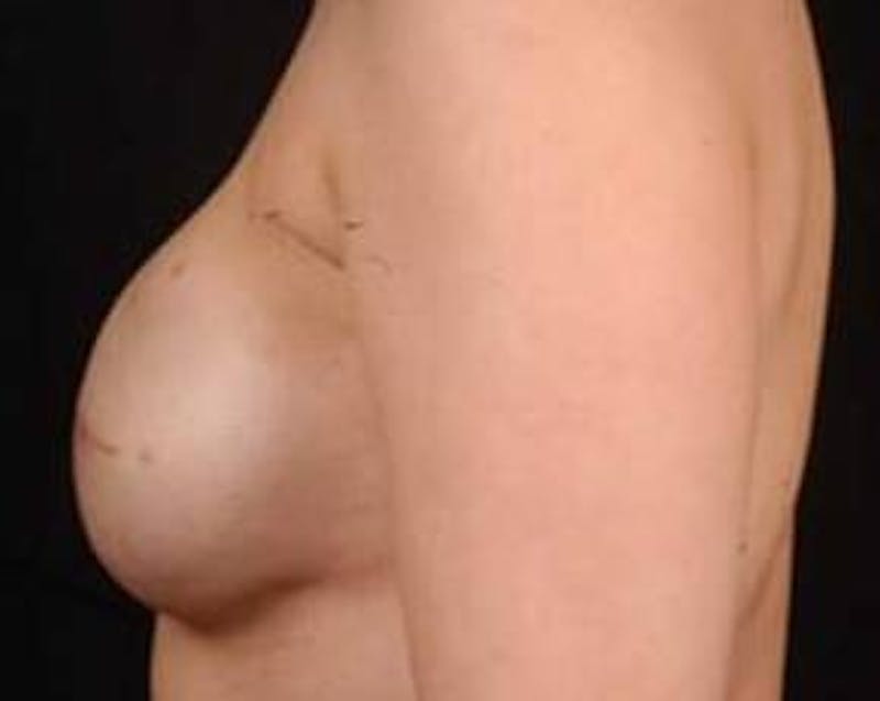 Immediate Breast Reconstruction – Flaps Before & After Gallery - Patient 264346 - Image 3