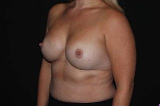 Breast Augmentation Silicone Gel Before & After Gallery - Patient 976078 - Image 4
