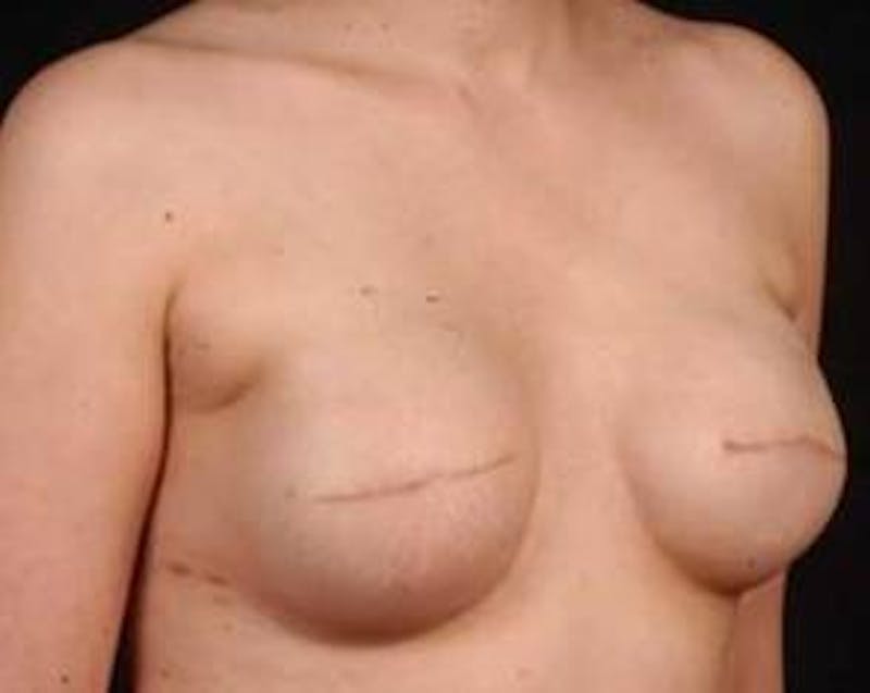 Immediate Breast Reconstruction – Flaps Before & After Gallery - Patient 264346 - Image 5