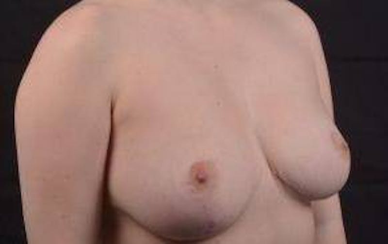 Breast Reduction Before & After Gallery - Patient 303669 - Image 9