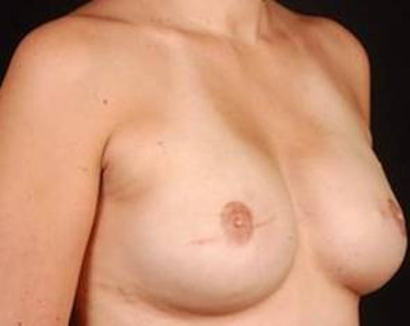 Immediate Breast Reconstruction – Flaps Before & After Gallery - Patient 264346 - Image 6
