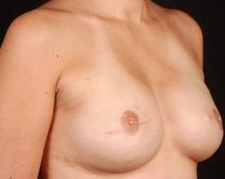 Immediate Breast Reconstruction – Flaps Before & After Gallery - Patient 264346 - Image 6