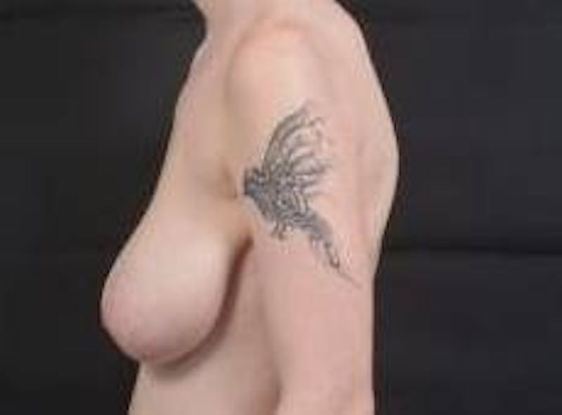 Breast Reduction Before & After Gallery - Patient 230682 - Image 3