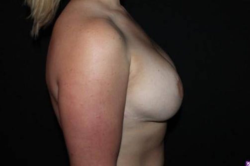 Aesthetic Breast Revision Before & After Gallery - Patient 388541 - Image 9