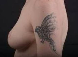 Breast Reduction Before & After Gallery - Patient 230682 - Image 4