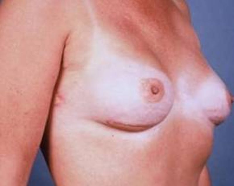 Immediate Breast Reconstruction – Flaps Before & After Gallery - Patient 655918 - Image 4