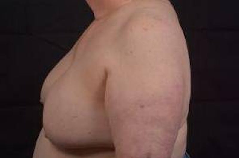Breast Augmentation Mastopexy Before & After Gallery - Patient 339508 - Image 3
