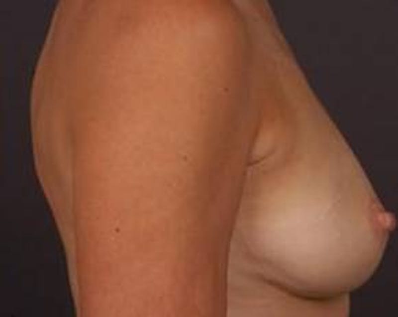 Prophylactic Mastectomy Before & After Gallery - Patient 198563 - Image 3