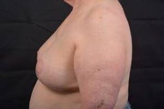 Breast Augmentation Mastopexy Before & After Gallery - Patient 339508 - Image 4