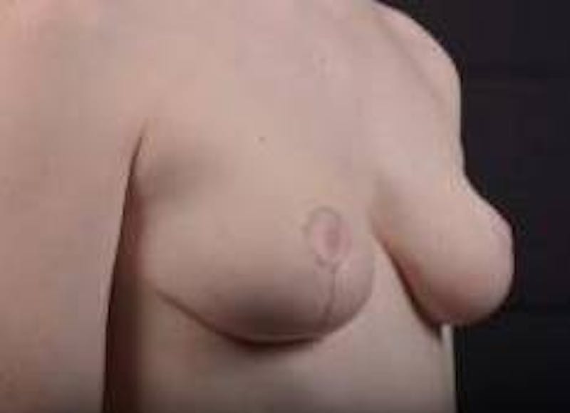 Breast Reduction Before & After Gallery - Patient 230682 - Image 10