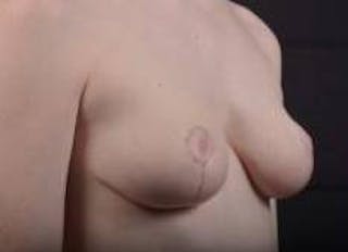 Breast Reduction Before & After Gallery - Patient 230682 - Image 10