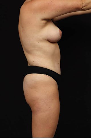Mastopexy Before & After Gallery - Patient 275634 - Image 10