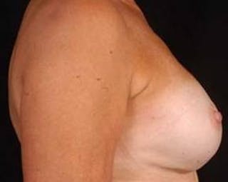 Prophylactic Mastectomy Before & After Gallery - Patient 198563 - Image 4