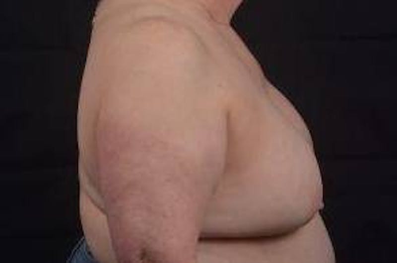 Breast Augmentation Mastopexy Before & After Gallery - Patient 339508 - Image 5