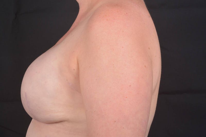 Immediate Breast Reconstruction – Skin Sparing Before & After Gallery - Patient 186303 - Image 4
