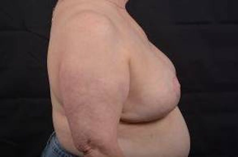 Breast Augmentation Mastopexy Before & After Gallery - Patient 339508 - Image 6