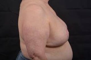 Breast Augmentation Mastopexy Before & After Gallery - Patient 339508 - Image 6