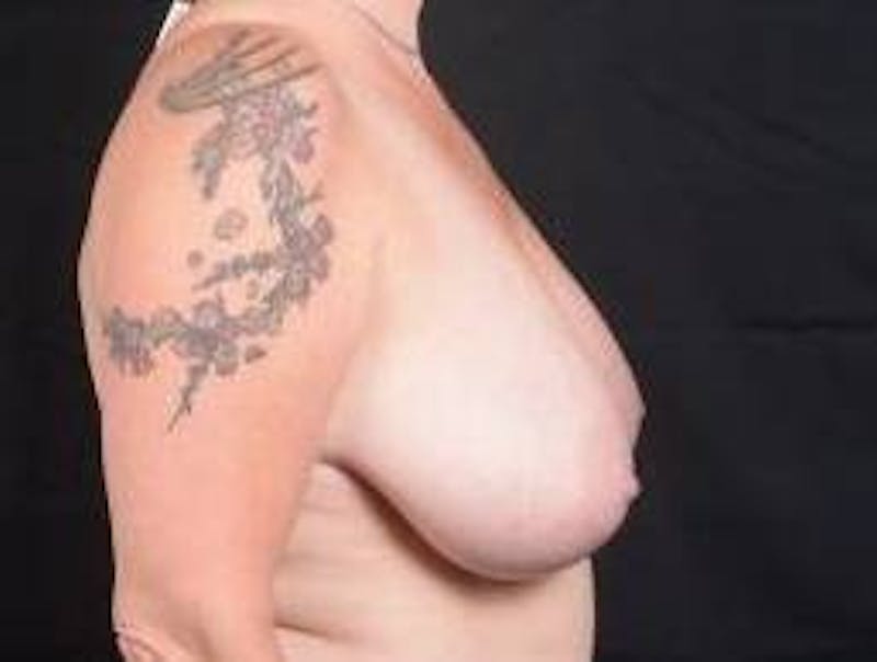 Breast Reduction Before & After Gallery - Patient 187058 - Image 5