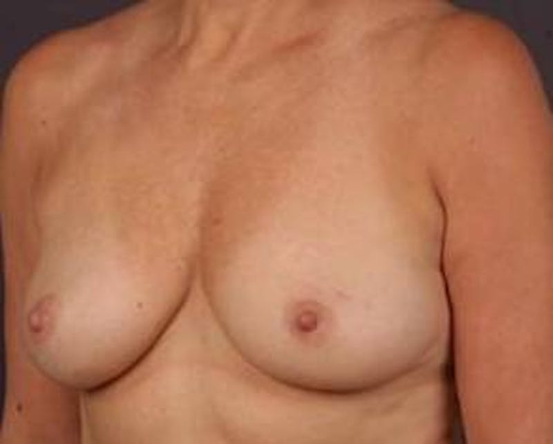 Prophylactic Mastectomy Before & After Gallery - Patient 198563 - Image 5