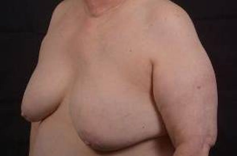 Breast Augmentation Mastopexy Before & After Gallery - Patient 339508 - Image 7