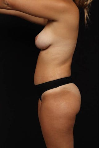 Mastopexy Before & After Gallery - Patient 295726 - Image 6