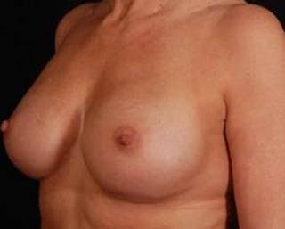 Prophylactic Mastectomy Before & After Gallery - Patient 198563 - Image 6