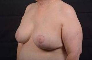 Breast Augmentation Mastopexy Before & After Gallery - Patient 339508 - Image 8