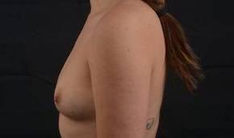 Immediate Breast Reconstruction – Nipple Sparing Before & After Gallery - Patient 385996 - Image 3
