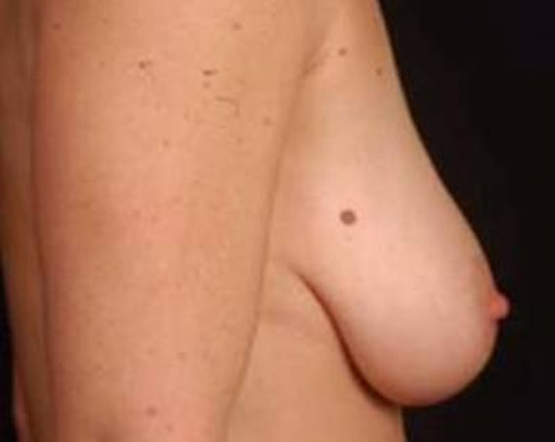 Prophylactic Mastectomy Before & After Gallery - Patient 252516 - Image 3