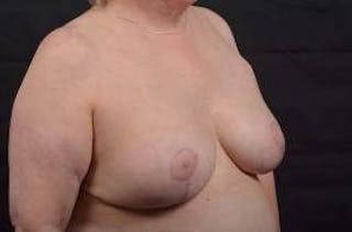 Breast Augmentation Mastopexy Before & After Gallery - Patient 339508 - Image 10