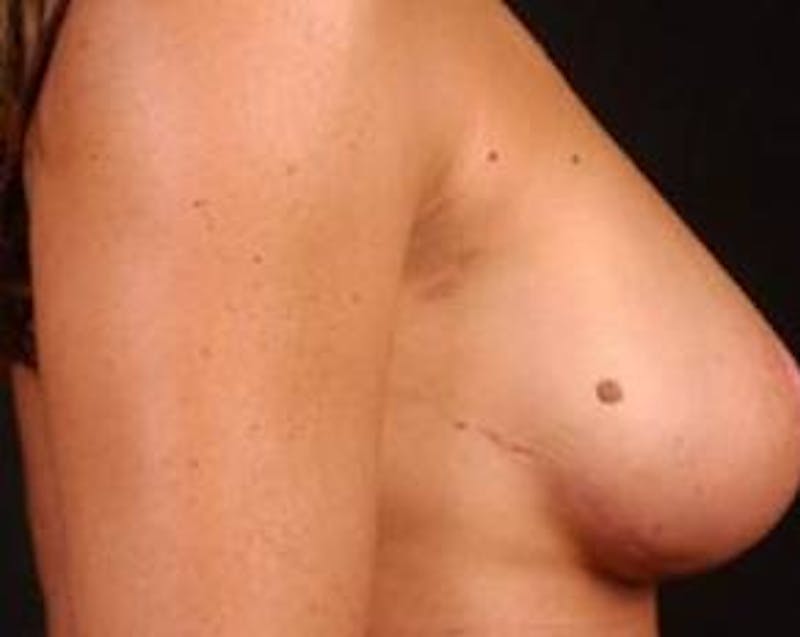 Prophylactic Mastectomy Before & After Gallery - Patient 252516 - Image 4