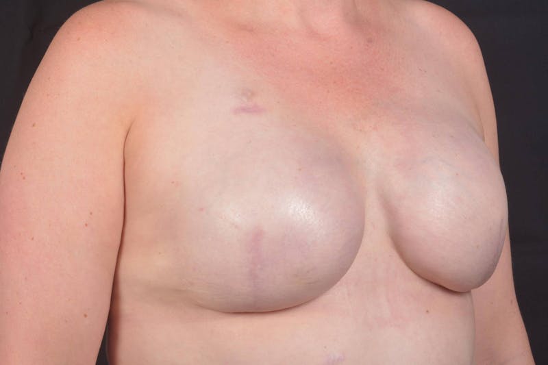 Immediate Breast Reconstruction – Skin Sparing Before & After Gallery - Patient 186303 - Image 10