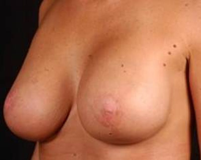 Prophylactic Mastectomy Before & After Gallery - Patient 252516 - Image 6