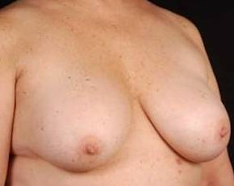 Prophylactic Mastectomy Before & After Gallery - Patient 282604 - Image 3