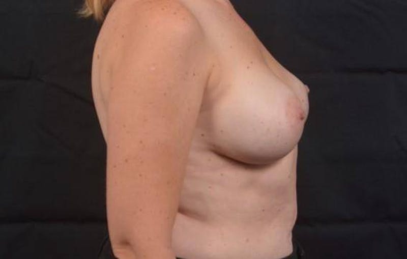 Aesthetic Breast Revision Before & After Gallery - Patient 241446 - Image 9