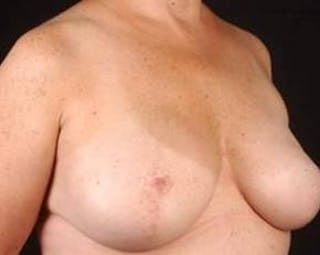 Prophylactic Mastectomy Before & After Gallery - Patient 282604 - Image 4