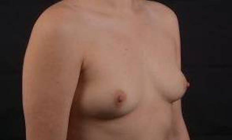 Immediate Breast Reconstruction – Nipple Sparing Before & After Gallery - Patient 385996 - Image 9
