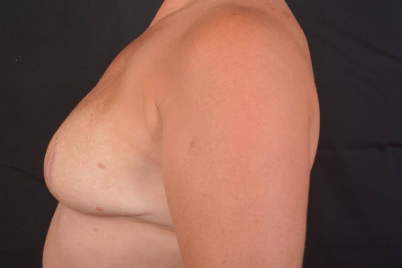 Immediate Breast Reconstruction – Skin Sparing Before & After Gallery - Patient 364612 - Image 4