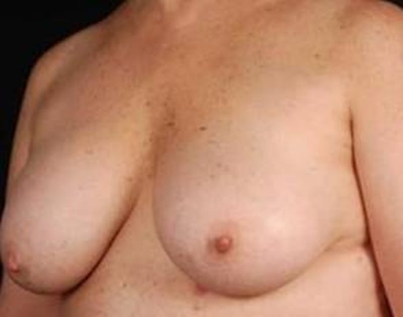 Prophylactic Mastectomy Before & After Gallery - Patient 282604 - Image 5