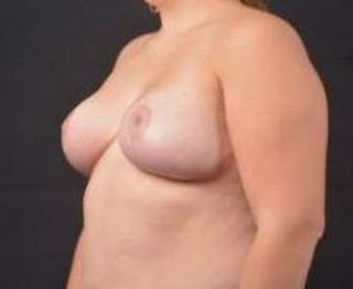 Breast Reduction Before & After Gallery - Patient 351277 - Image 8