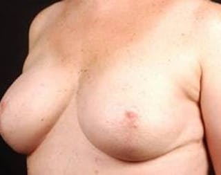Prophylactic Mastectomy Before & After Gallery - Patient 282604 - Image 6