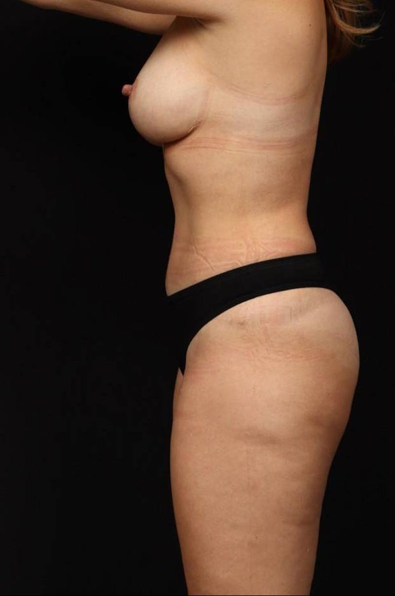 Mastopexy Before & After Gallery - Patient 152108 - Image 6
